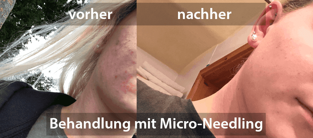 Behandlung mit Micro-Needling